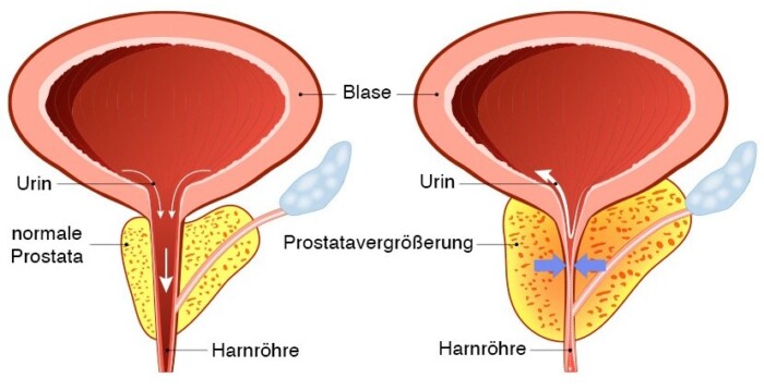 Gutartige Prostatahyperplasie