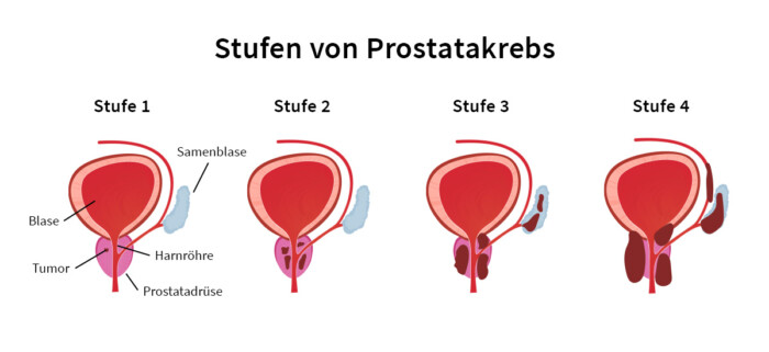 Entstehung von Prostatakrebs