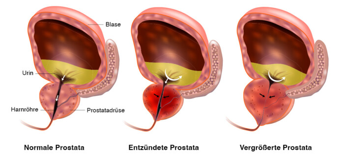 Querschnitt durch die Prostata: Vergleich von gesunder, entzündeter und vergrößerter Prostata